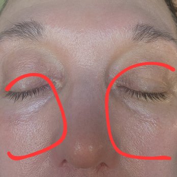 ReDerm MD Medical Spa - Damage to under eyes post Halo/BBL - Medical Spas Near Me - Denver, Colorado ReDerm MD Medical Spa - Damage to under eyes post Halo/BBL - Medical Spas Near Me - Denver, Colorado