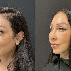 Adam Weinfeld, MD - Surgery before and after
