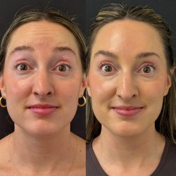Zuliani Facial Aesthetics - Dysport results