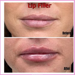 BeautyFi - Juvederm, Versa and more. Get bigger lips instantly!!!!