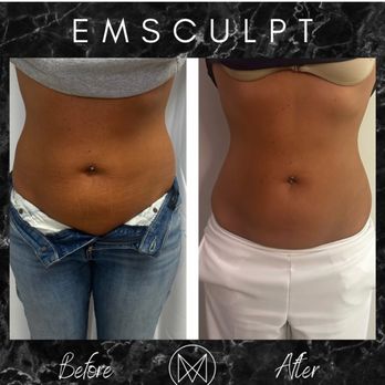 Mona Beauty Loft - Emsculpt before and after - Eyelash Service Near Me - Ashburn, Virginia Mona Beauty Loft - Emsculpt before and after - Eyelash Service Near Me - Ashburn, Virginia