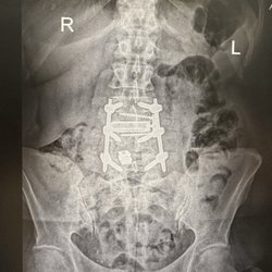 Jaswinder Grover MD - Spacer/cage/screws/plates L3-4-5