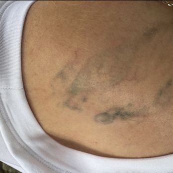 LaserXX - After 6 sessions - Tattoo Removal Near Me - Los Angeles, California LaserXX - After 6 sessions - Tattoo Removal Near Me - Los Angeles, California