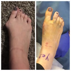 Ashkan Soleymani, DPM - Cedars Foot and Ankle Center - Left is night before surgery and right is exactly a week later. Such an improvement already!