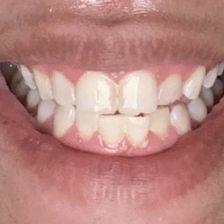 Pure White Teeth Whitening