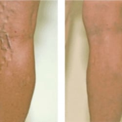 Farshad Malekmehr, MD - Varicose Veins before & after