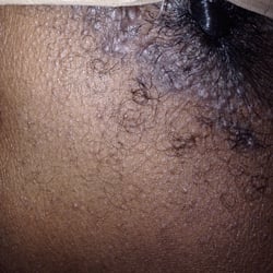 Flokay Hair Braiding Salon - Rash from having my hair twisted here.