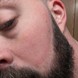 Barbers Empire - Irritated skin