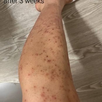 SEV Laser - Laser Hair Removal Near Me - Burlingame, California