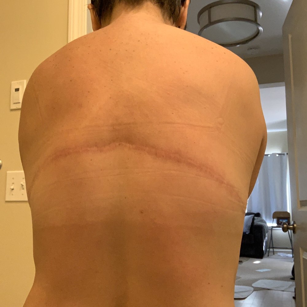 CosMed - You can see the hideous Frankenstein scar 2 years post procedure! Grotesque and unprofessional results for a cosmetic procedure. - Cosmetic Surgeons Near Me - Tijuana, BCN