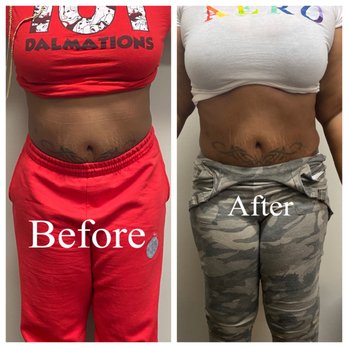 Bella Body Spa - Non- Invasive Laser Lipo, get rid of unwanted fat. Belly, tights, arms chin and back. No down time and painless. - Waxing Near Me - Reisterstown, Maryland Bella Body Spa - Non- Invasive Laser Lipo, get rid of unwanted fat. Belly, tights, arms chin and back. No down time and painless. - Waxing Near Me - Reisterstown, Maryland