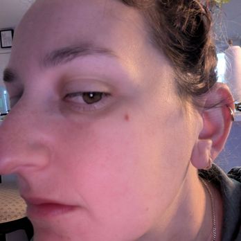 Whispering Day Spa - Butchered face from badly done extraction. - Day Spas Near Me - San Diego, California Whispering Day Spa - Butchered face from badly done extraction. - Day Spas Near Me - San Diego, California