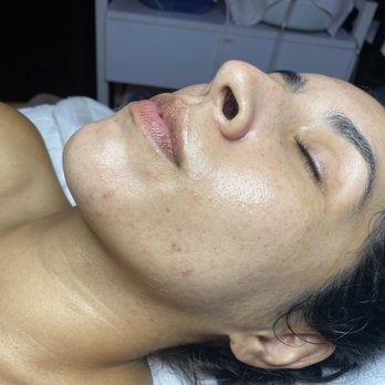 Glow Advanced Skin and Body Care - After 5 months, left side - Skin Care Near Me - Temecula, California Glow Advanced Skin and Body Care - After 5 months, left side - Skin Care Near Me - Temecula, California