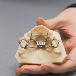 Nova Orthodontics - Rapid Palatal Expander "RPE"