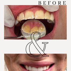 Keen Family Dentistry - Anterior Zirconia Crowns Completed by Dr. Keen