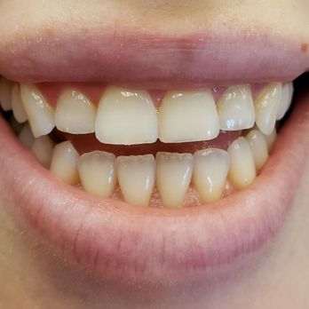 Central Valley Dentistry - Teeth shaved - Cosmetic Dentists Near Me - Phoenix, Arizona