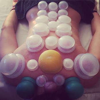 Haven Wellbeing - Cupping Therapy - Acupuncture Near Me - Miami Beach, Florida