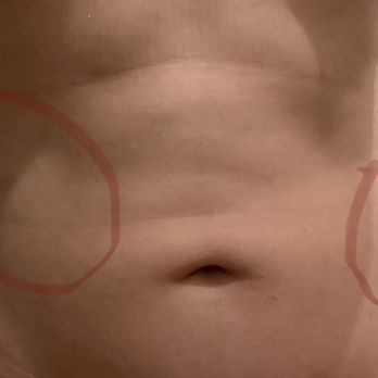Richard Dale Reynolds - Lumpy Lipo - Plastic Surgeons Near Me - El Paso, Texas Richard Dale Reynolds - Lumpy Lipo - Plastic Surgeons Near Me - El Paso, Texas