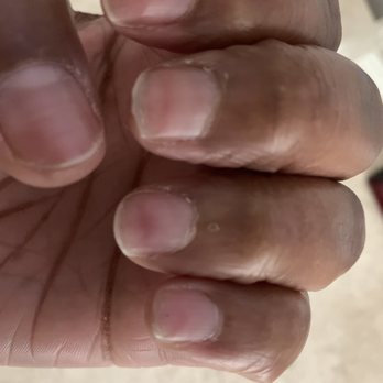 VIP Nails & Spa - 1 month after nail damage - Nail Salons Near Me - Chicago, Illinois VIP Nails & Spa - 1 month after nail damage - Nail Salons Near Me - Chicago, Illinois
