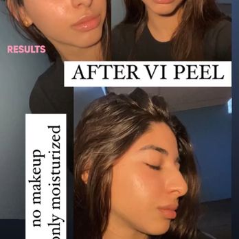 THE SKN LOUNGE - Chemical peel results - Eyelash Service Near Me - Birmingham, Michigan THE SKN LOUNGE - Chemical peel results - Eyelash Service Near Me - Birmingham, Michigan