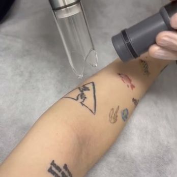 Milan Medical - Tattoo removal - Medical Spas Near Me - Arcadia, California Milan Medical - Tattoo removal - Medical Spas Near Me - Arcadia, California