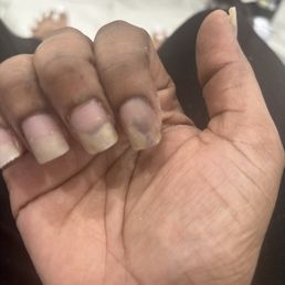 Fungus after biogel