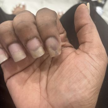 Bio gel Nails - Fungus after biogel - Nail Salons Near Me - Los Angeles, California