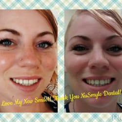 NuSmyle Dental - Thank You for fixing My Teeth!! Dr Hurst is Incredible!!! I Cried after i saw my teeth!! Seriously Amazing Work!!