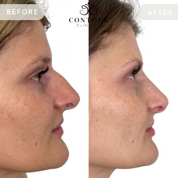 Contour Clinique - Before/After Nose Filler - Aestheticians Near Me - Oldsmar, Florida Contour Clinique - Before/After Nose Filler - Aestheticians Near Me - Oldsmar, Florida