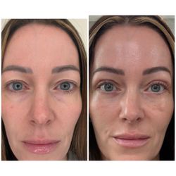 Ivan Vrcek, MD - Before and 2 weeks after surgery