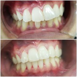 Ajmal Dental Care - Before & After braces