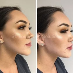 St. Louis Skin Solutions - Facial Balancing using Dermal Fillers to the jawline and lips