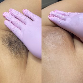 Bes Beauty - brazilian sugar wax before and after - Teeth Whitening Near Me Bes Beauty - brazilian sugar wax before and after - Teeth Whitening Near Me
