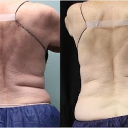 Greer Plastic Surgery - Before and after CoolSculpting