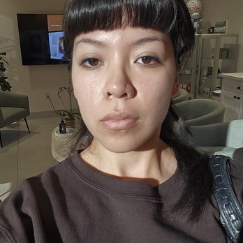 MeSO Medspa - after results - Skin Care Near Me - Anaheim, California MeSO Medspa - after results - Skin Care Near Me - Anaheim, California