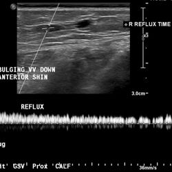 Vein Specialists of Santa Barbara - Ultrasound of vein reflux behind varicose veins