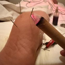 Soho Acupuncture Center - Plantar fasciitis pain from running and stranding