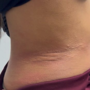 Premier Allergy Asthma & Immunology - Hives - Immunodermatologists Near Me - Phoenix, Arizona