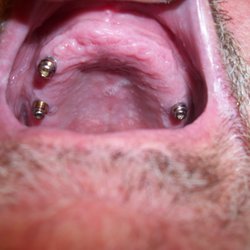 Robert C Vogel, DDS - 3 implants were literally plucked out by 2 fingers after only 7 years