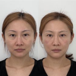 Jonathan Brock, MD - Under eye filler