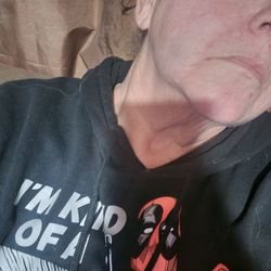 Fairfield Oral Surgery and Implantology - This lighter bruise is from her fingers