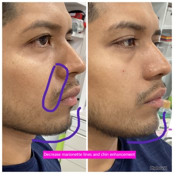 Younger You Medispa - Enhance chin, decrease marionette lines with filler to look younger - Medical Spas Near Me - Moorpark, California Younger You Medispa - Enhance chin, decrease marionette lines with filler to look younger - Medical Spas Near Me - Moorpark, California