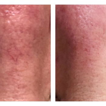 Village Aesthetics - Facial telangiectasia be gone - Medical Spas Near Me - Plano, Texas