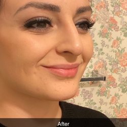 Michelle Norvell Aesthetics - After michelle injected my nose