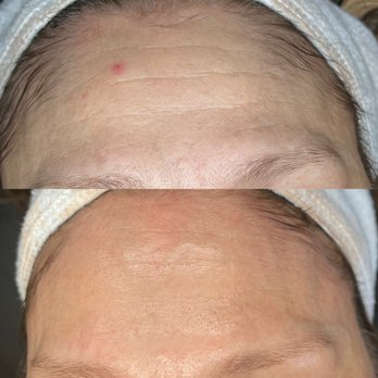 Sadowski Aesthetics & Laser - Microneedling 2 treatments - Laser Hair Removal Near Me - Seattle, Washington Sadowski Aesthetics & Laser - Microneedling 2 treatments - Laser Hair Removal Near Me - Seattle, Washington