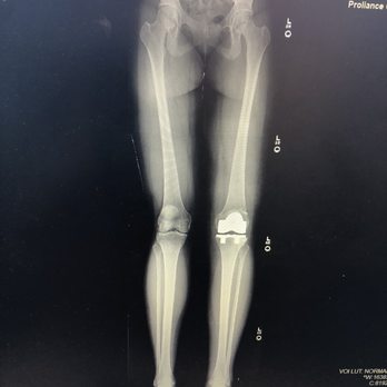 Jonah B. Hulst, MD - Proliance Orthopedic and Sports Medicine - Orthopedists Near Me - Issaquah, Washington Jonah B. Hulst, MD - Proliance Orthopedic and Sports Medicine - Orthopedists Near Me - Issaquah, Washington