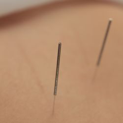 Help U Heal Healing Arts - Acupuncture