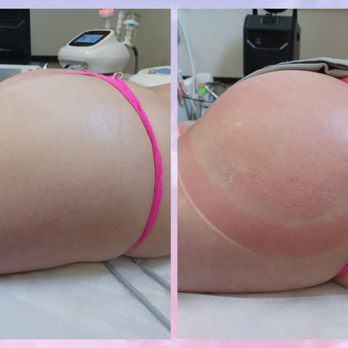 Total Image Master Body Sculpting - Lift Shape butty lift - Body Contouring Near Me - Vallejo, California Total Image Master Body Sculpting - Lift Shape butty lift - Body Contouring Near Me - Vallejo, California