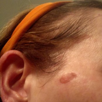 Michael Lin, MD - Just some of the many blisters I was left with - Dermatologists Near Me - Sherman Oaks, California Michael Lin, MD - Just some of the many blisters I was left with - Dermatologists Near Me - Sherman Oaks, California