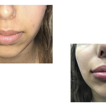 Benjamin P Caughlin MD, FACS - Lips are HOT these days! - Cosmetic Surgeons Near Me - Chicago, Illinois
